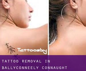 Tattoo Removal in Ballyconneely (Connaught)