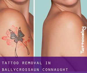 Tattoo Removal in Ballycrossaun (Connaught)