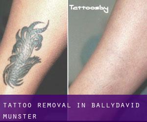 Tattoo Removal in Ballydavid (Munster)