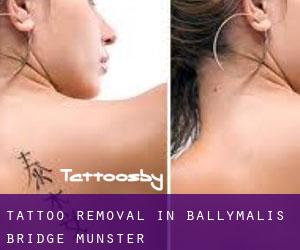 Tattoo Removal in Ballymalis Bridge (Munster)