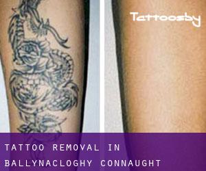 Tattoo Removal in Ballynacloghy (Connaught)