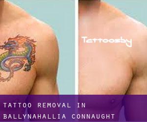 Tattoo Removal in Ballynahallia (Connaught)