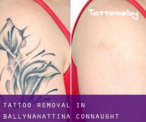 Tattoo Removal in Ballynahattina (Connaught)