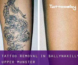 Tattoo Removal in Ballynakilly Upper (Munster)