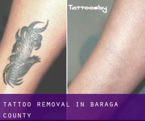 Tattoo Removal in Baraga County