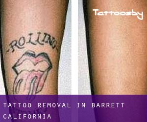 Tattoo Removal in Barrett (California)