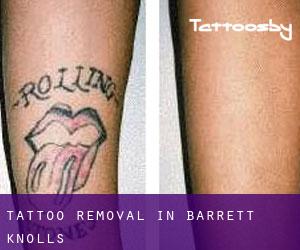 Tattoo Removal in Barrett Knolls