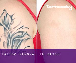 Tattoo Removal in Bassu