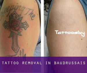 Tattoo Removal in Baudrussais