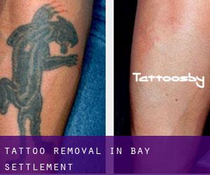 Tattoo Removal in Bay Settlement