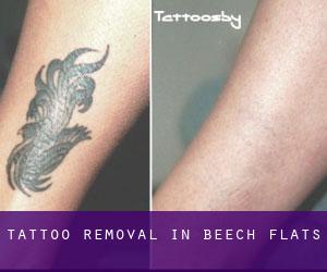 Tattoo Removal in Beech Flats