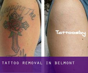Tattoo Removal in Belmont