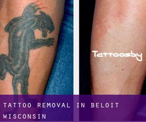 Tattoo Removal in Beloit (Wisconsin)
