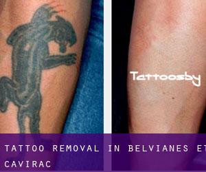 Tattoo Removal in Belvianes-et-Cavirac