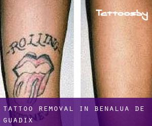 Tattoo Removal in Benalúa de Guadix