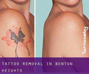 Tattoo Removal in Benton Heights