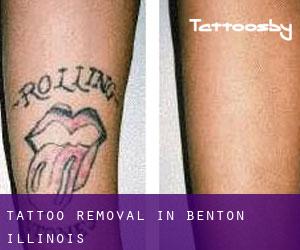 Tattoo Removal in Benton (Illinois)