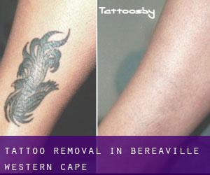 Tattoo Removal in Bereaville (Western Cape)