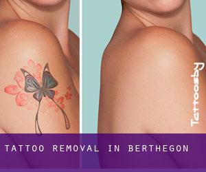 Tattoo Removal in Berthegon