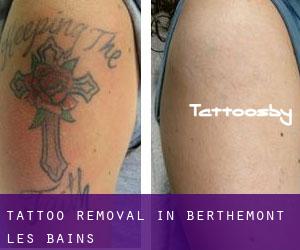 Tattoo Removal in Berthemont-les-Bains