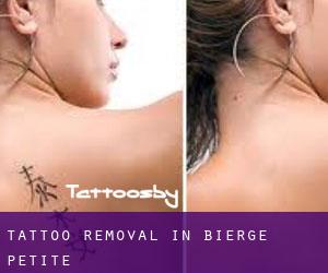 Tattoo Removal in Bierge Petite