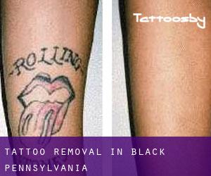 Tattoo Removal in Black (Pennsylvania)