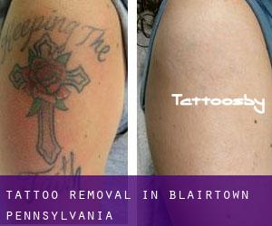 Tattoo Removal in Blairtown (Pennsylvania)