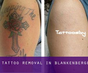 Tattoo Removal in Blankenberge