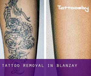 Tattoo Removal in Blanzay