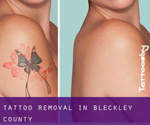 Tattoo Removal in Bleckley County
