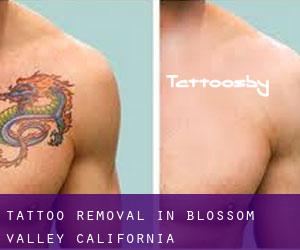 Tattoo Removal in Blossom Valley (California)