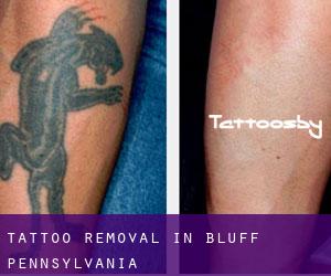 Tattoo Removal in Bluff (Pennsylvania)