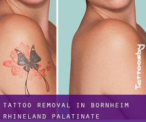 Tattoo Removal in Bornheim (Rhineland-Palatinate)