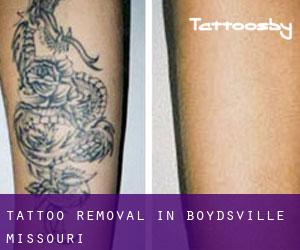 Tattoo Removal in Boydsville (Missouri)