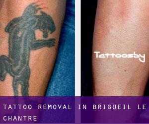 Tattoo Removal in Brigueil-le-Chantre