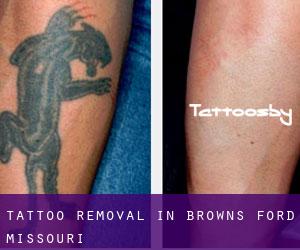 Tattoo Removal in Browns Ford (Missouri)