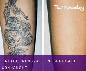 Tattoo Removal in Bungowla (Connaught)