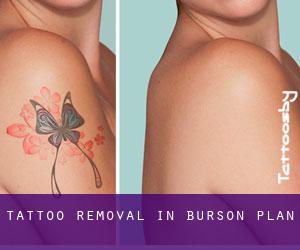 Tattoo Removal in Burson Plan