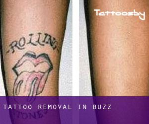 Tattoo Removal in Buzz