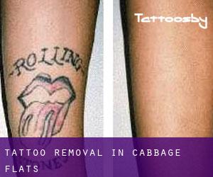 Tattoo Removal in Cabbage Flats