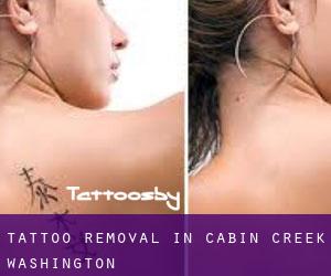 Tattoo Removal in Cabin Creek (Washington)