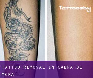 Tattoo Removal in Cabra de Mora