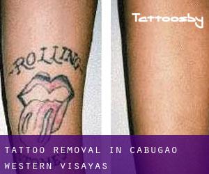 Tattoo Removal in Cabugao (Western Visayas)