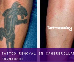 Tattoo Removal in Cahererillan (Connaught)