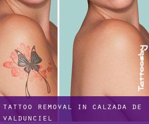 Tattoo Removal in Calzada de Valdunciel