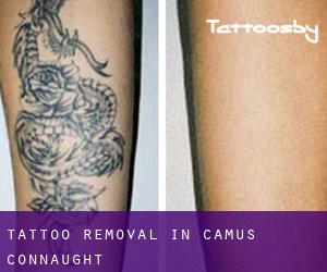 Tattoo Removal in Camus (Connaught)