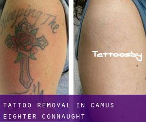 Tattoo Removal in Camus Eighter (Connaught)