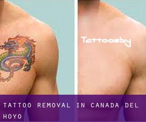 Tattoo Removal in Cañada del Hoyo