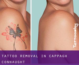 Tattoo Removal in Cappagh (Connaught)