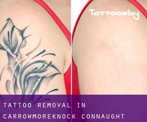 Tattoo Removal in Carrowmoreknock (Connaught)